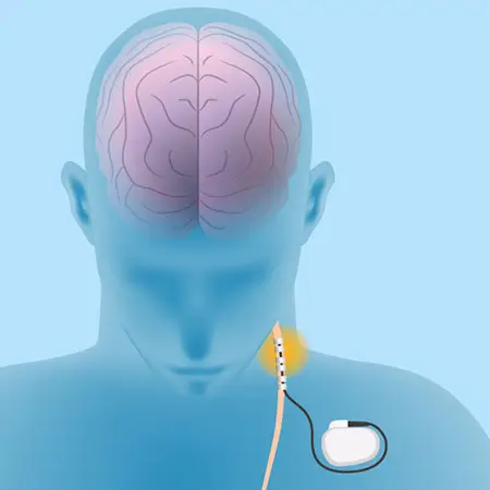 Diagram showing vagus nerve stimulation VNS device for epilepsy treatment