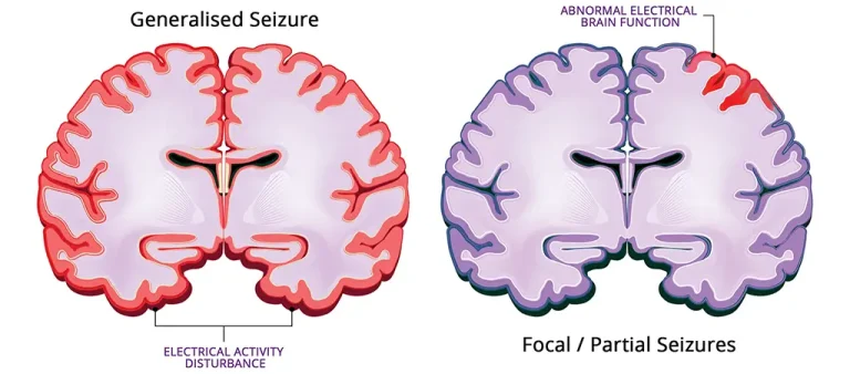Educational diagram comparing generalised seizures and focal partial seizures showing brain electrical activity disturbance