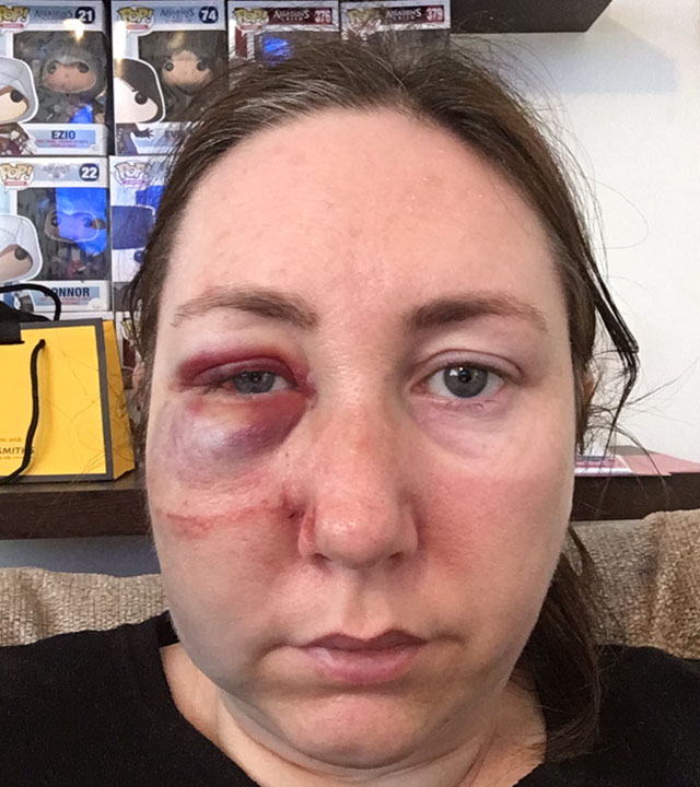 Michelle Hackett showing facial injury from epilepsy seizure, sharing her personal journey story
