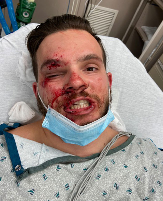 Jackson Kissel in hospital bed after epilepsy seizure with facial injuries, showing the serious impact of the condition
