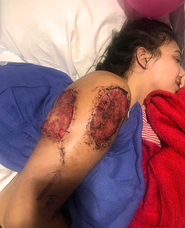 Isabella Stefanoski recovering in hospital after epilepsy surgery showing surgical wounds on head and arm