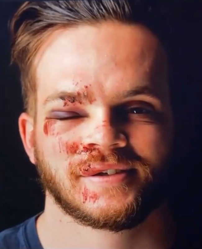 Jackson Kissel showing facial injuries from epilepsy seizure, sharing the reality of living with the condition
