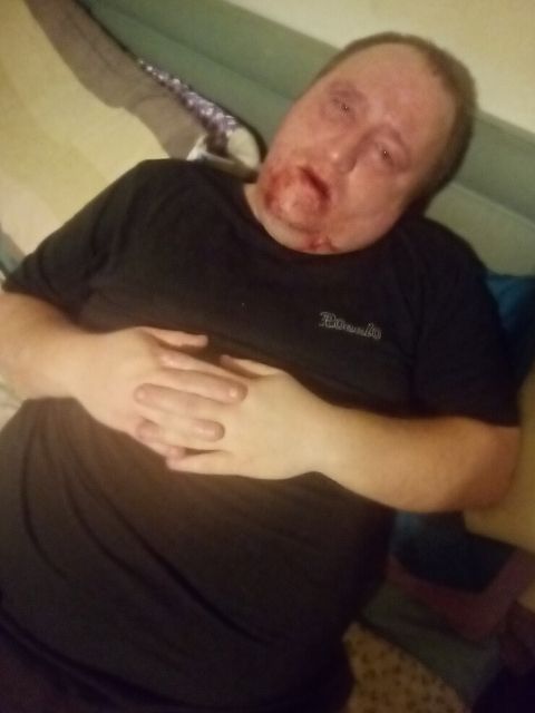 Jonathan experiencing an epilepsy seizure, showing the reality of living with the condition
